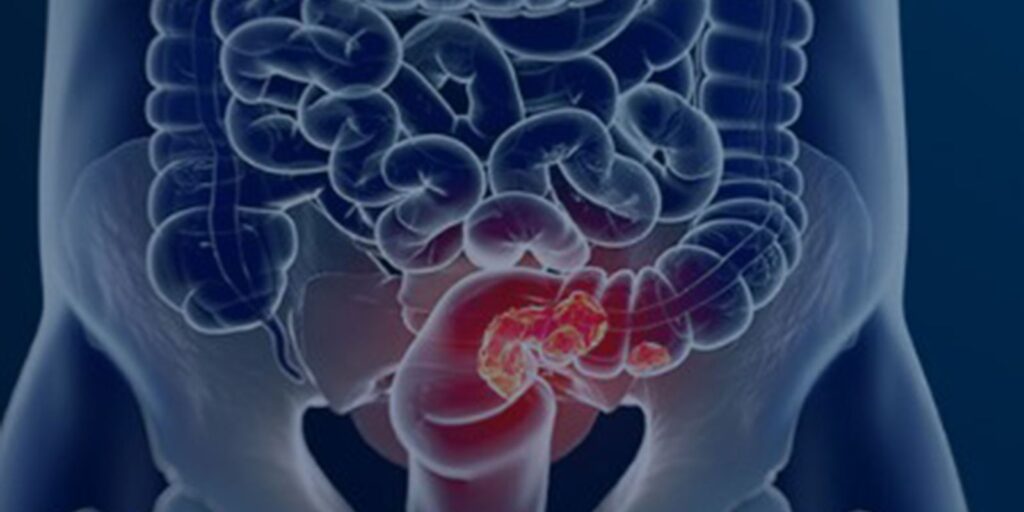 sus-adota-novo-exame-para-rastrear-cancer-colorretal-na-populacao
